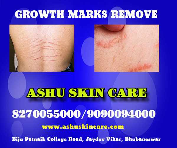best growth marks remove treatment clinic in bhubaneswar near me